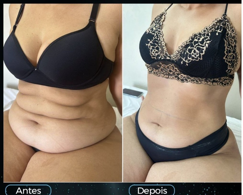 Registro de evolução do contorno abdominal feminino